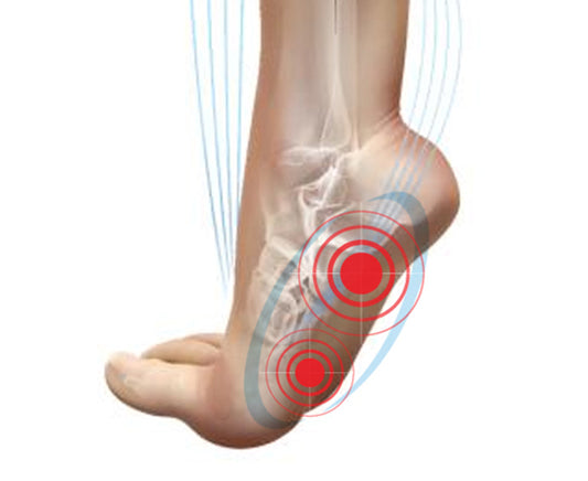 Aching Arches / Plantar Fasciitis / Heel Spurs